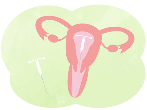 避妊アイテム（ミレーナ）