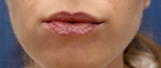 Naklejka premium Women's unattractive unattractive lips with peeling, wounds and hiccups in the corners