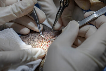 Hair transplantation process, pulling hair follicles back and replanting them. Riyadh Saudi Arabia...