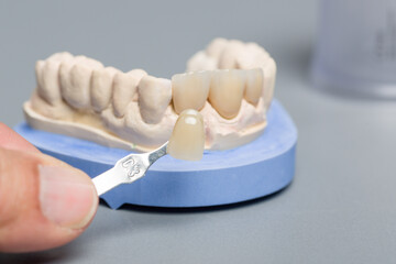 close up of checking veneer of tooth crown or implant with a shade guide in dental laboratory