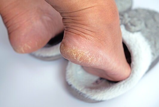 A woman foot  in winter slipper with dried skin problem. Focus on deep crack dry heel on the foot with bad skin is covered with rough cracks skin.