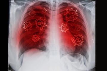  Chest x-ray Film with Covid 19 Virus