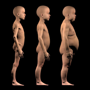 Undernourished child, with normal build and obese child in comparison. Problems of food shortage and obesity in children. 3d render 
