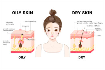 Oily & dry skin. Different. Human Skin types and conditions. A diagrammatic sectional view of the skin. 
