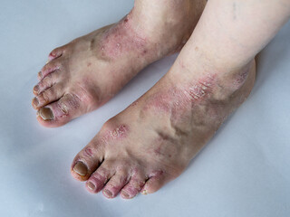 Closeup of the legs of a woman suffering from chronic psoriasis on a white background. Closeup of rash and scaling on the patient's skin. Dermatological problems. Dry skin. Isolated.