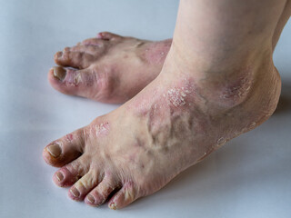 Closeup of the legs of a woman suffering from chronic psoriasis on a white background. Closeup of...
