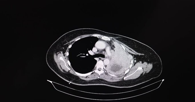 inema CT scan of a chest of a patient with lung cancer. The tumor causes total left lung atelectasis and pleural effusion.