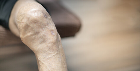 Close up of old man hand holding on the knee with suffering from knee pain. The sick legs of an old man with severely deformed knees affected by arthritis.