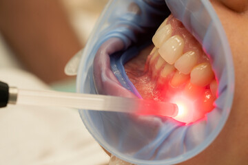 dental therapy with red LED lightred light therapy in a dental office