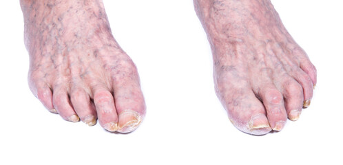 Sick nails on foot. Toenail fungus isolated on white. Sore toe-nail, nail fungus
