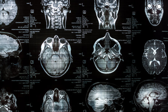 Magnetic Resonance Imaging Of The Brain Close Up. MRI