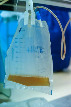 Urine bag medical treatment drainage bladder rubber flexible body infection bacteria output measure tract toilet leg relieve cancer device calculi vesical problem anatomy sterile surgical urethra.