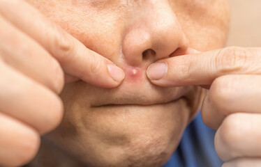 Acne pimple problem on nose in Asian woman skin face close up.