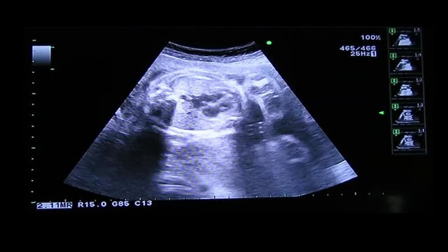 Heart of human embryo on an ultrasound display, Monitor showing the four-chamber view
