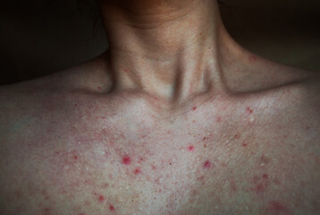 Naklejka premium Blackheads and pimples in the décolleté area. Woman with problem skin. Clogged pores.