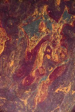 human cells, well differentiated squamous cell carcinomas