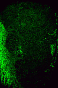human cells, basal cell cancer of eyes