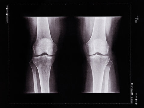 X-ray of a knee of a senior person