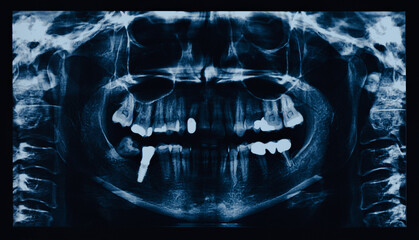 Dental X-Rays of a human jaw