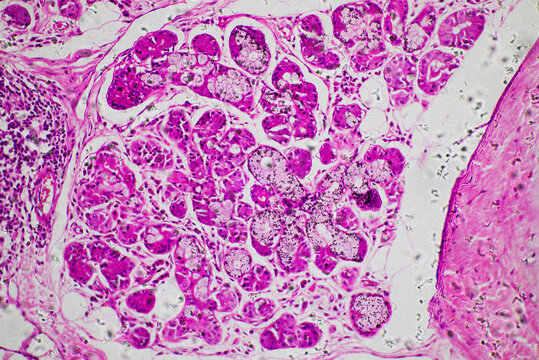 Squamous metaplasia of bronchial mucosa