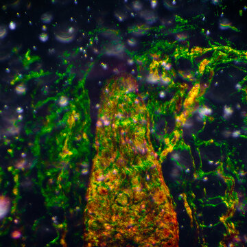 Squamous metaplasia of bronchial mucosa