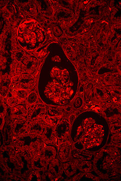Human kidney proximal tubule epithelial cloudy swelling