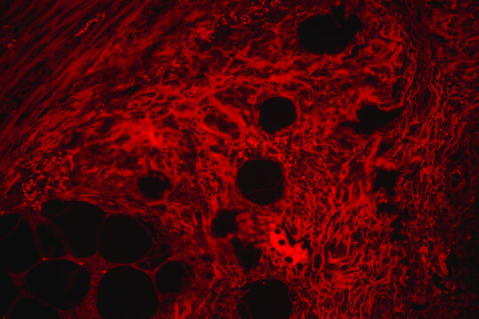 Suppurative inflammation of human appendix