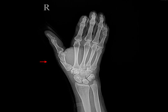 Xray of a hand of a patient with fractured bone in the hand