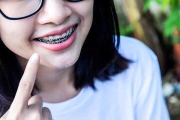 Asian woman wearing dental braces pointing to tooth sample and smiling with her healthy white teeth