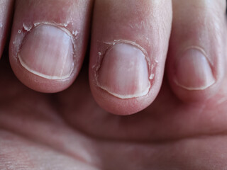 Bitten, poorly maintained fingernails. Bad habit due to emotional disorder. Pedicure and body care...