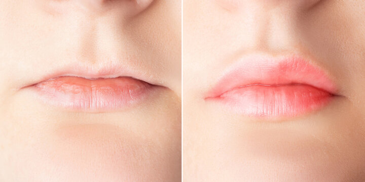 Lip augmentation before and after close up. Woman lips surgery, filler injection, mesotherapy, correction