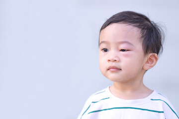 Asian baby boy is bitten by mosquitoes, allergy to insect bites unrecognizable swollen eye, Dermatitis problem of rash.Blank space for text.
