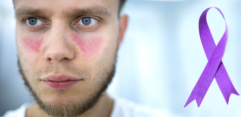 Man suffering from lupus, violet ribbon awareness symbol Pancreatic cancer, Alzheimer's disease, epilepsy, lupus, World Cancer Day