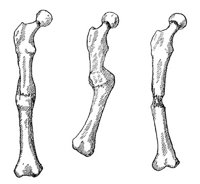 Examples of fused bones after a fracture. Correct (left) and incorrect (center, right) - with a shift and with the formation of nonunion. Illustration of the 19th century. Germany. White background.