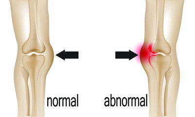 Joint pain illustration. Bone pain. Ache. Arthritis. Orthopedic medical concept.