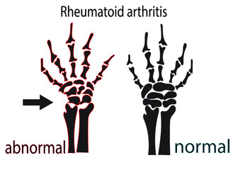 Illustration of Rheumatiod arthritis, Joint pain. Wrist pain.
