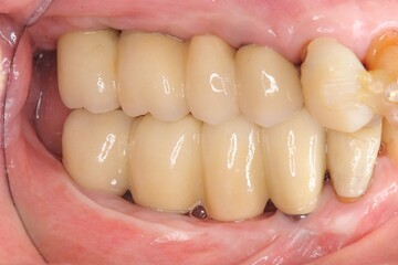 インプラント治療