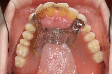 歯の喪失　入れ歯