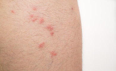 Fototapeta premium flea bites on caucasian man leg