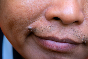 Obraz premium Asian middle-aged man face with Skin disease.Closeup mole on male face.Moles on the lips.