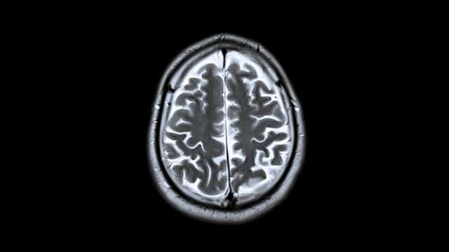 Brain Mr. Healthcare Concept. Magnetic Resonance Imaging of Human Brain. Checking Cranium. Scanning of Man Head. MRI.