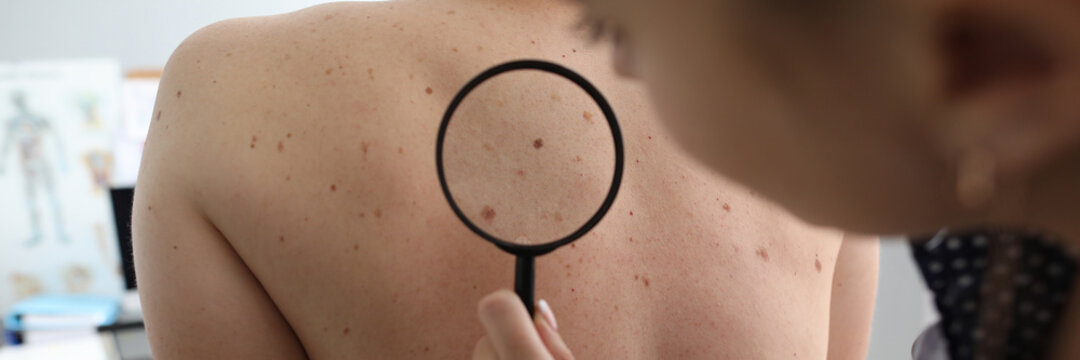 Doctor oncologist with magnifying glass in his hand examines pigmented nevi on patient's back in clinic. Diagnostics and treatment of malignant skin tumors concept.