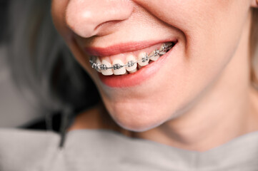 Close up of young woman with charming smile demonstrating white teeth with orthodontic brackets....