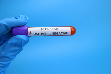Obraz premium Doctor, nurse keep positive blood test for coronavirus