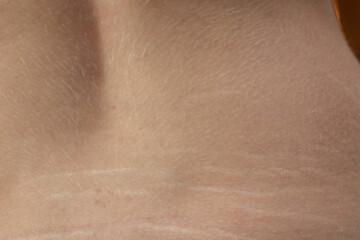 Woman showing stretch marks on her back. Scars from stretch marks on the back of the lower back