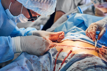 Close up of male surgeon in sterile gloves placing sutures after tummy tuck surgery. Man doctor...