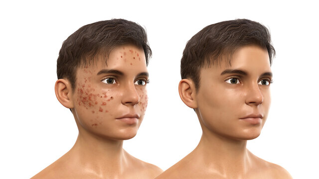 Acne vulgaris in a teenager boy. Before and after treatment