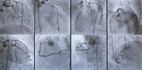 Coronary angiogram , medical x-ray for heart disease. Coronary artery disease.