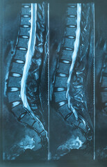 X- ray MRI of lumbosacral spine (L-S spine) case of low back pain. Normal x-ray MRI lumbosacral...