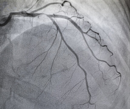 Coronary angiogram , medical x-ray for heart disease. Coronary artery disease.